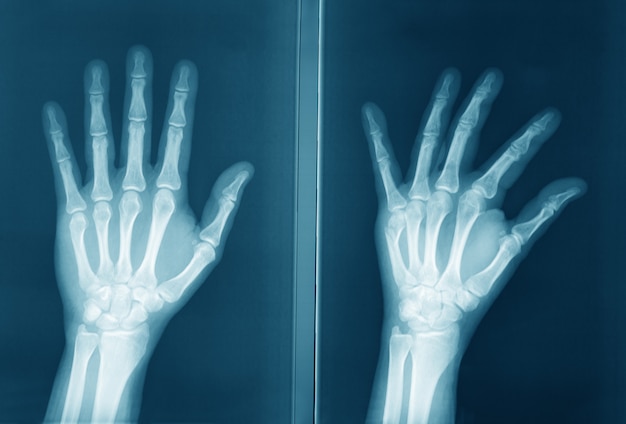 人間の手の元の放射線撮影