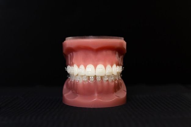 写真 歯列矯正顎モデル、セラミックブラケットまたはブレース付きのデモンストレーション歯