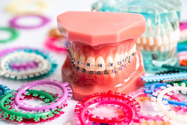 Ортодонтические связки кольца и связи эластичные резинки на ортодонтических брекетах модель для стоматолога, изучающего стоматологию