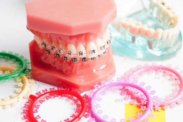 Ортодонтические лигатуры, кольца и завязки, эластичные резиновые ленты на модели ортодонтических брекетов для стоматолога, изучающего стоматологию