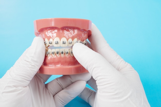 Orthodontic model and dentist tool - demonstration teeth model of varieties of orthodontics