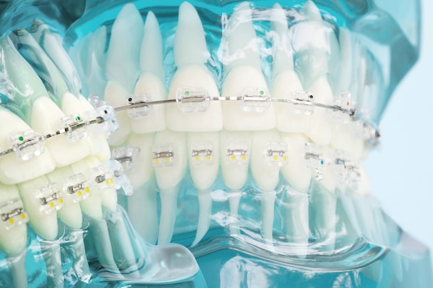 Orthodontic model and dentist tool - demonstration teeth model of varities of orthodontic bracket or brace