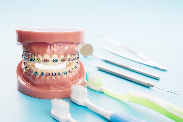 치열 교정 모델 및 치과 의사 도구-치열 교정의 다양성의 데모 치아 모델