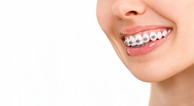 Orthodontische behandeling tandheelkundige zorg Concept mooie vrouw gezonde glimlach close-up close-up keramische en metalen beugels op tanden mooie vrouwelijke glimlach met bretels