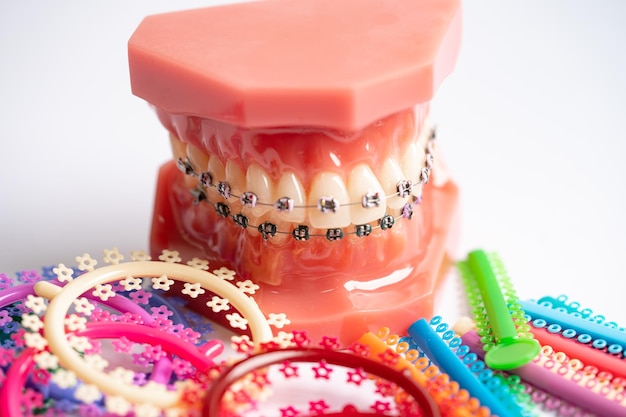 Orthodontische ligaturen, ringen en banden, elastische elastiekjes op orthodontisch beugelmodel voor tandartsen die over tandheelkunde studeren