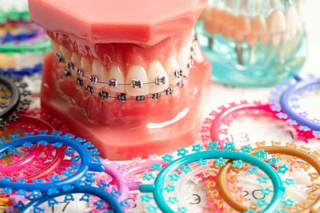 Orthodontische ligaturen ringen en banden elastische rubberen banden op orthodontische beugels model voor tandarts die studeert over tandheelkunde