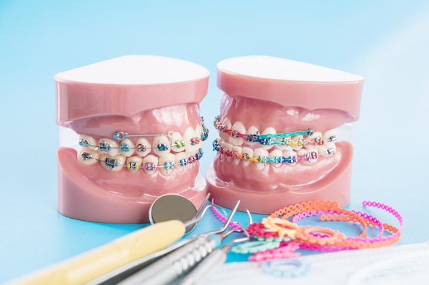 Orthodontische model en tandarts tool - demonstratie tanden model van verschillende soorten orthodontie