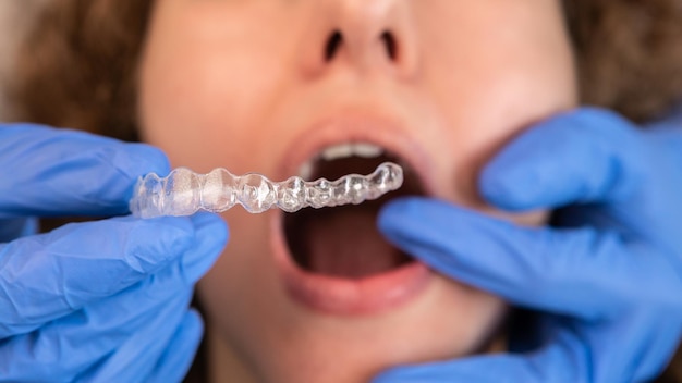 Orthodontist arts die siliconen onzichtbare transparante beugels op vrouwentanden zet