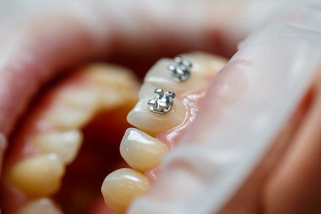 The orthodontist puts metal braces on the patient's teeth. Orthodontic dental treatment. High quality photo