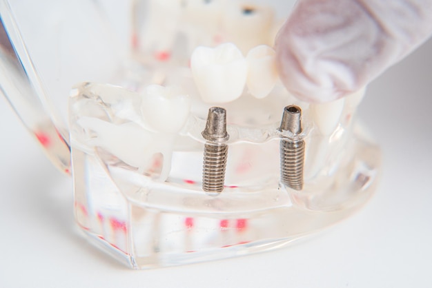 Orthodontist shows how to insert the implant Macro