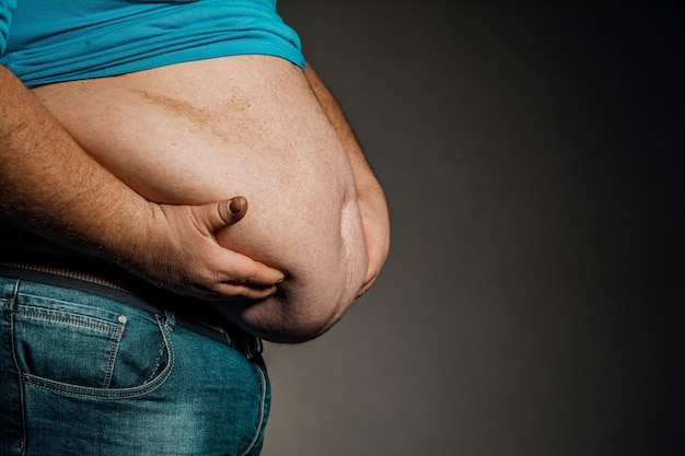 Overweight of a person's body with hands touching the abdomen The concept of obesity