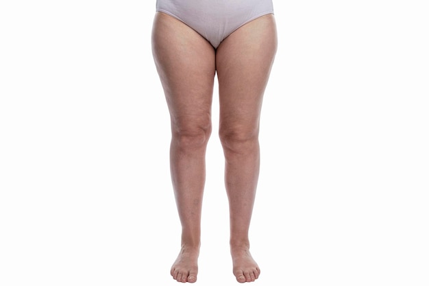 Overweight woman in panties with cellulite and varicose veins on her legs Obesity and disease Isolated on white background