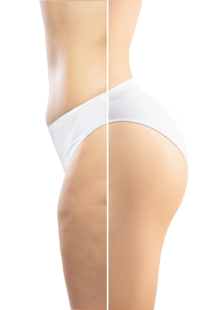 Donna sovrappeso con cellulite gambe e glutei in biancheria intima bianca a confronto con corpo in forma e sottile isolato su sfondo bianco. pelle a buccia d'arancia, liposuzione, sanità, bellezza, sport, chirurgia.