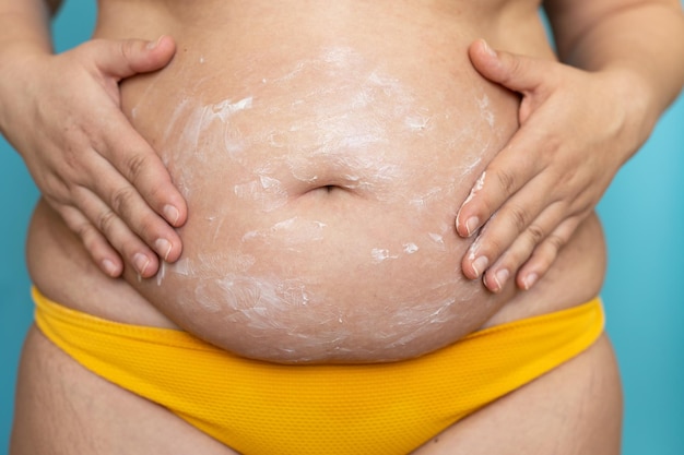 young woman in postpartum corrective tightening underwear shows her  overweight. The girl squeezes her excess belly fat with her hands after  childbirth Stock Photo