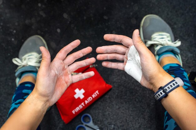 Palms with blisters corns on injured hands of intense lifting\
heavy weights patch on the palm