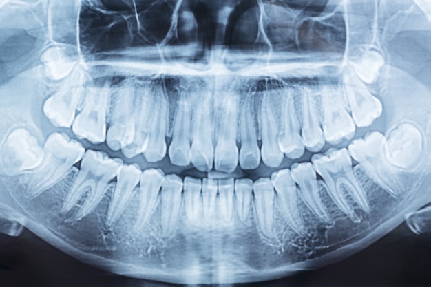 Radiografia dentale panoramica di una bocca a sinistra ea destra.