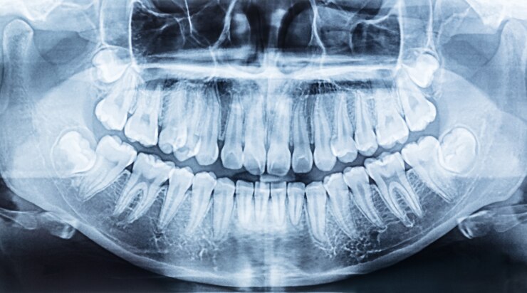 panoramic dental x-ray of a mouth left and right side.