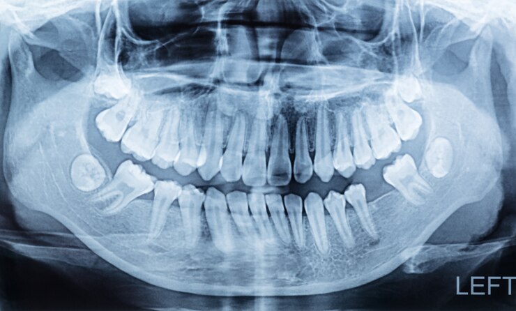 Panoramic dental x-ray of a mouth lift and right side.
