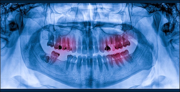 Foto immagine digitale panoramica a raggi x dentali della mascella superiore e inferiore scansione radiografica della mascella e della mandibola tomografia sul piano focale