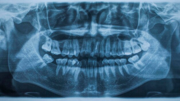 Panoramic dental XRay