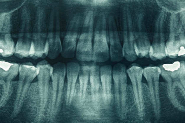 Photo panoramic dental xray