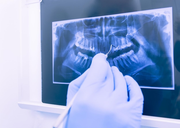 Foto panoramische tandheelkundige röntgenfoto