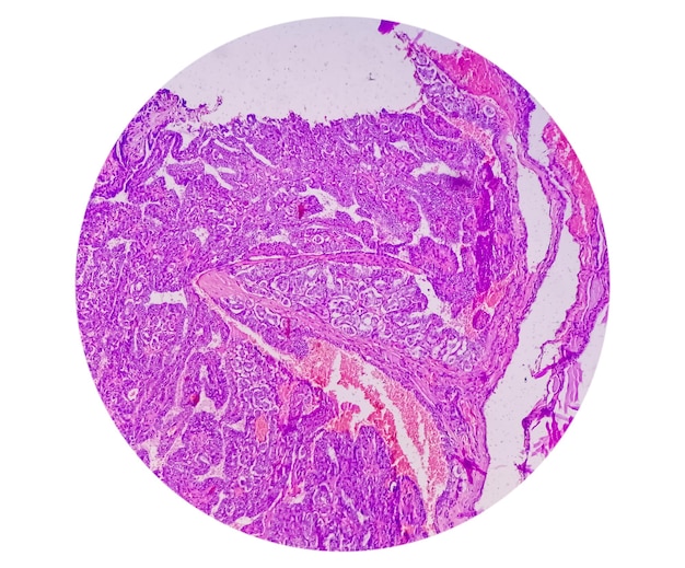 Papillair schildkliercarcinoom is de meest voorkomende vorm van kanker die uw schildklier aantast