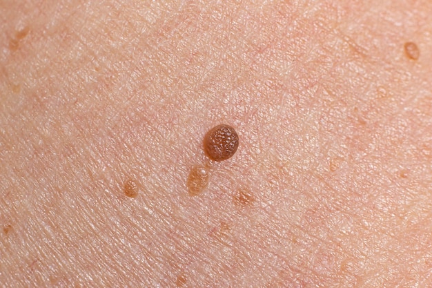 Papilloma on human skin benign tumor in the form of mole