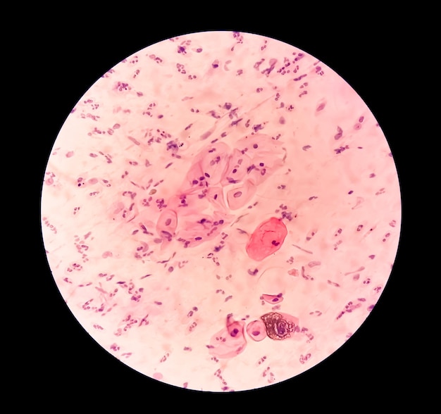 사진 파프 스미어 - hpv와 관련된 변화가 있는 염증 스미어 자궁경부암 scc