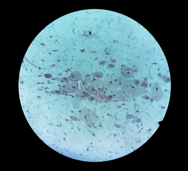 Photo paps smear inflammatory smear with hpv related changes cervical cancer scc