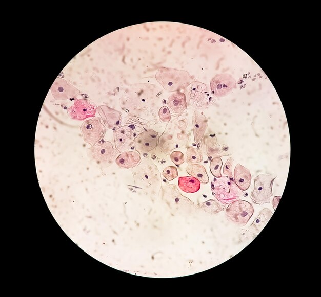 Photo paps smear inflammatory smear with hpv related changes cervical cancer scc