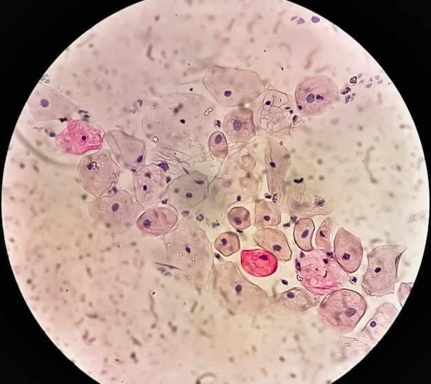 사진 파프 스미어 - hpv와 관련된 변화가 있는 염증 스미어 자궁경부암 scc