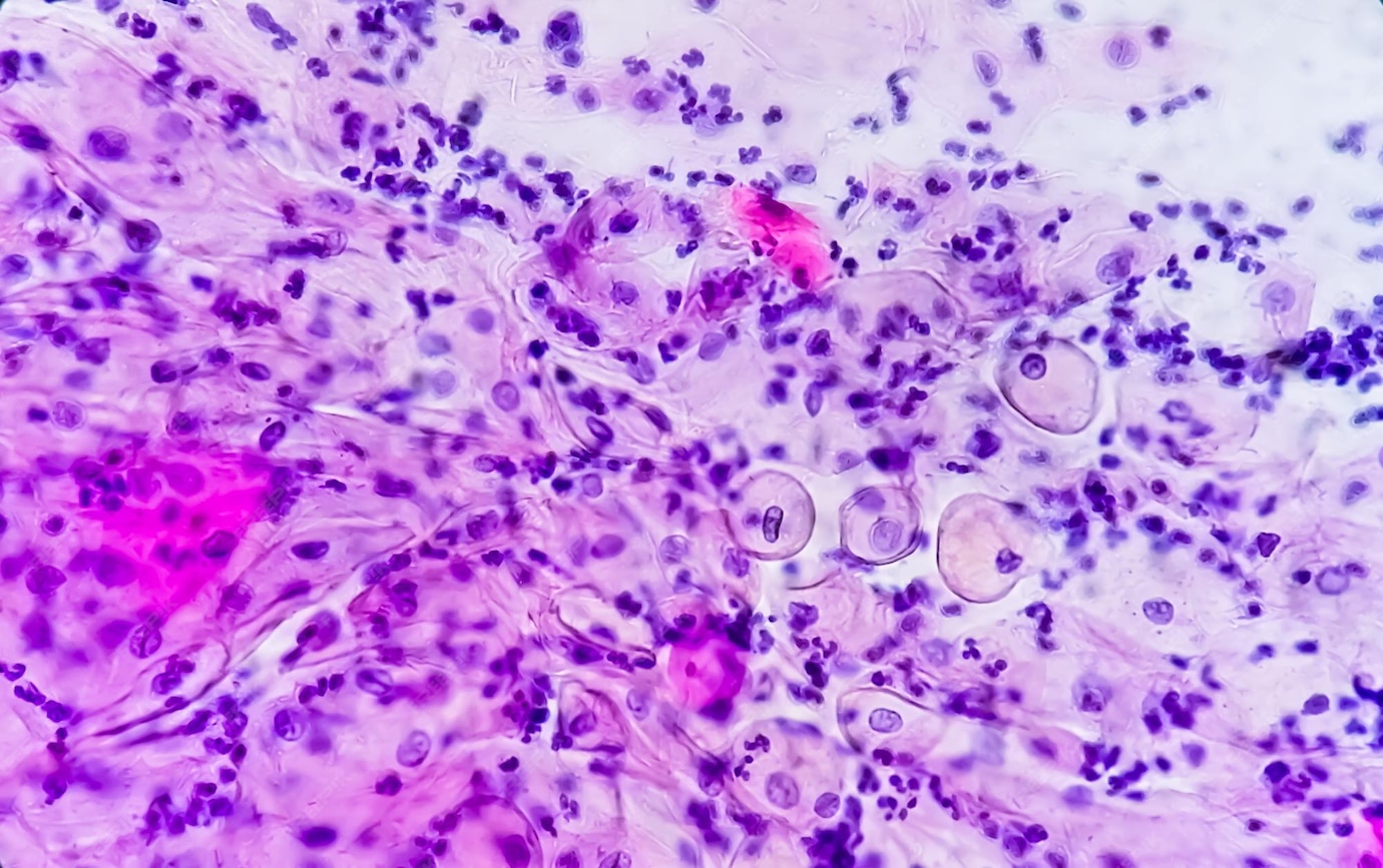 Premium Photo Paps smear. pap smear showing inflammatory smear with