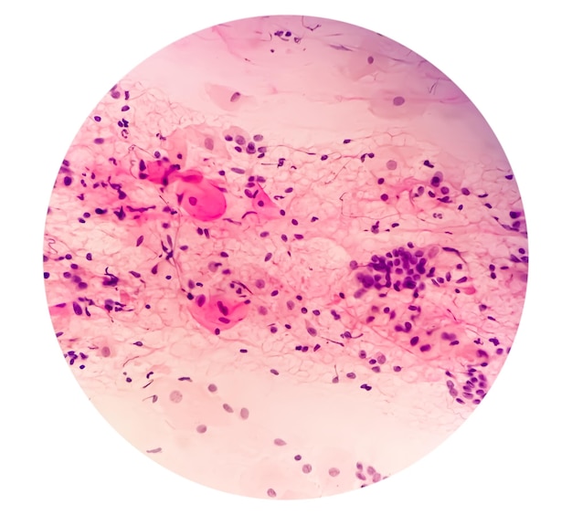 子宮の萎縮性変化を示す顕微鏡下の若い女性のPAPS塗抹標本研究