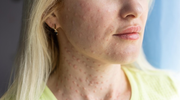 Papules after beauty injections on the face. Closeup photo