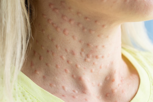 Papules after beauty injections on the face. Closeup photo