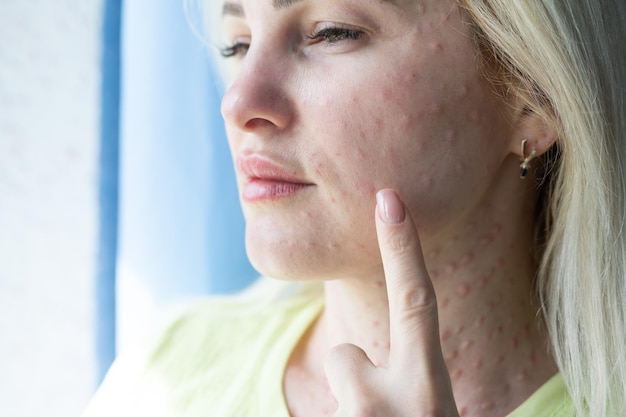 Papules after beauty injections on the face. Closeup photo