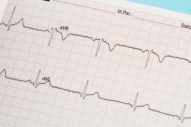 Photo part of an electrocardiogram printed in paper