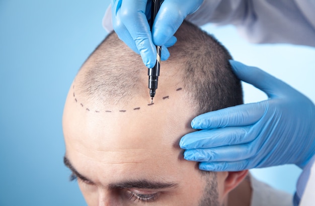 Photo patient suffering from hair loss in consultation with a doctor. doctor using skin marker