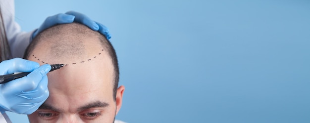 Patient suffering from hair loss in consultation with a doctor Space for your text