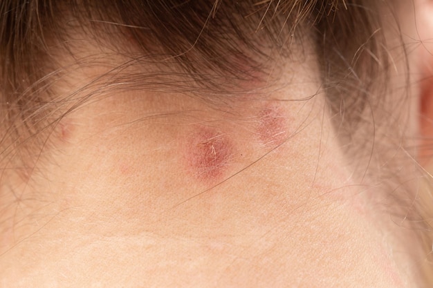 Pattern spots on skin