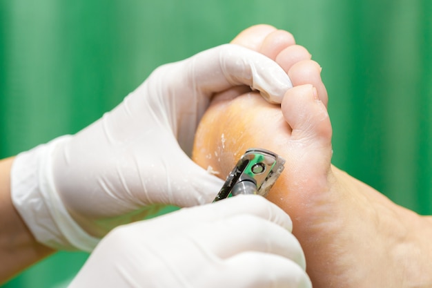 Procedura di pedicure nel salone di bellezza. calli emoverici sui piedi.