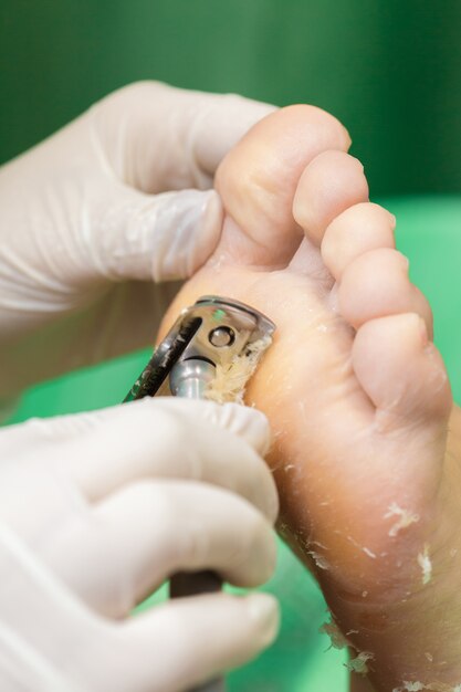 Procedura di pedicure nel salone di bellezza. calli emoverici sui piedi.