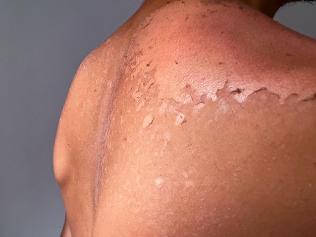 Peel rug en schouder huid van zonnebrand effect op jonge man lichaam