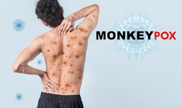 People with monkeypox on isolated background A person from back with monkeypox on his body Monkeypox virus concept Monkeypox virus outbreak pandemic design