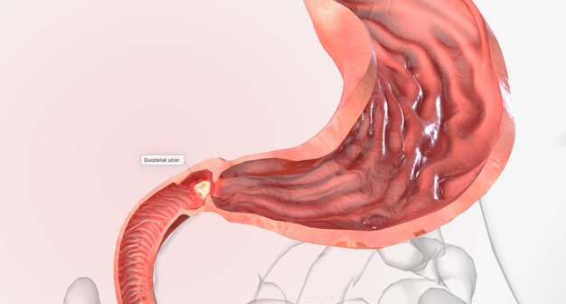 写真 消化性潰瘍 胃の胃潰瘍および十二指腸の小腸の最初の部分の十二指腸潰瘍