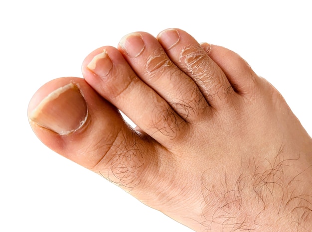 A person's toe is shown with the word toe on the bottom Right foot elongated claws and calloused