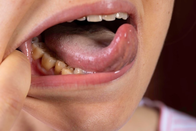 Foto persona che mostra denti gialli in bocca aperta da vicino