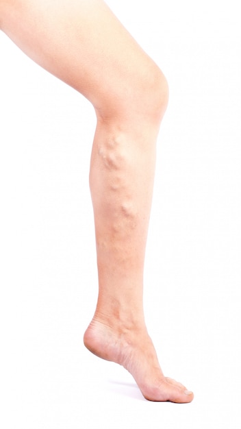 Foto malattia del flebeurisma sulle gambe su fondo bianco