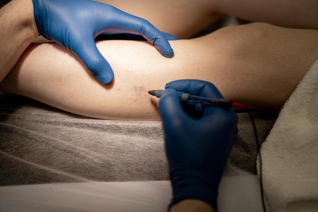 Phlebologist performs sclerotherapy on the veins of womens leg